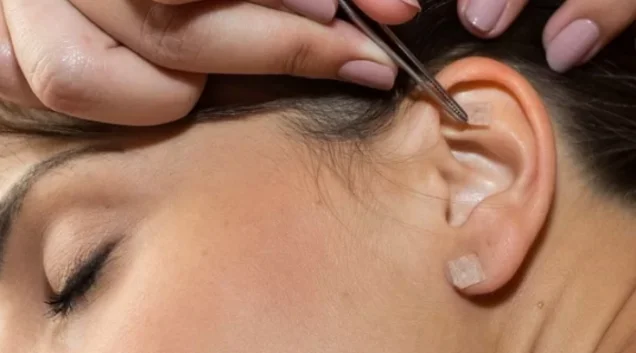 Auriculoterapia