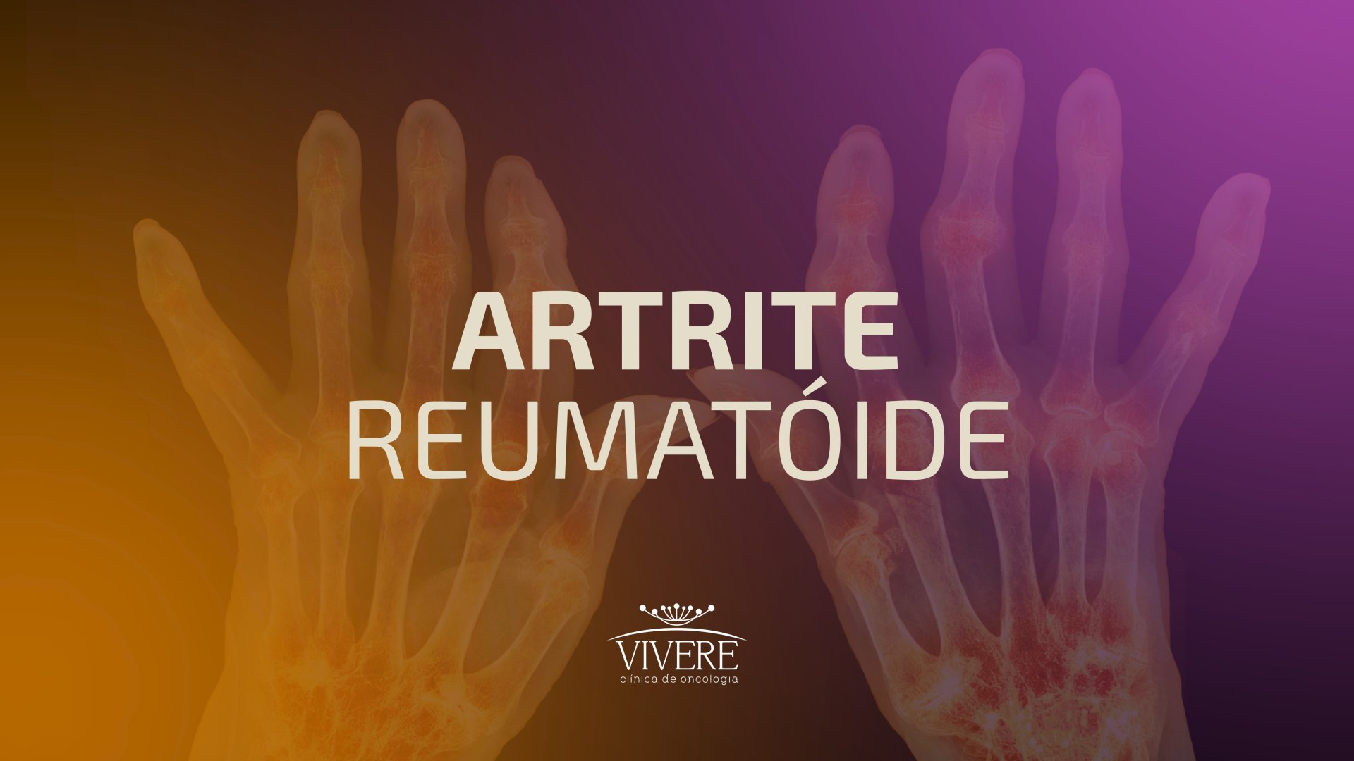 Artrite reumatoide: sintomas e formas de tratamento